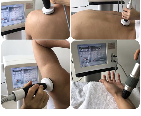 shock wave therapy for peripheral neuropathy radial pressure wave shockwave achilles tendinopathy